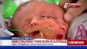 澳洲一对夫妇产下双面女婴 不同脸却两眼相连